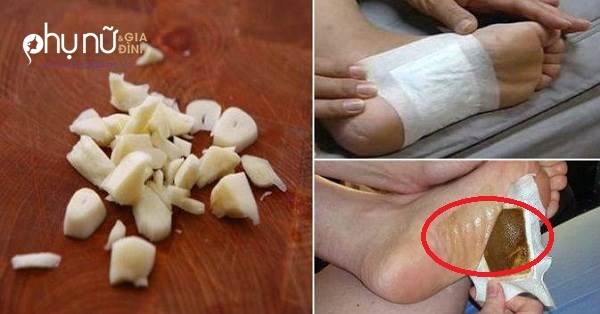 Giã nát tép tỏi đắp lên gan bàn chân rồi đi ngủ, kết quả sáng hôm sau khiến mọi người thực sự sốc Giã nát tép tỏi đắp lên gan bàn chân rồi đi ngủ, kết quả sáng hôm sau khiến mọi người thực sự sốc