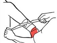 CÁC BƯỚC CẦM MÁU TẠM THỜI CÁC BƯỚC CẦM MÁU TẠM THỜI